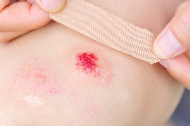 Waspada! Infeksi Bakteri "Pemakan Daging" Melonjak di Jepang, Apa yang Perlu Kamu Tahu?