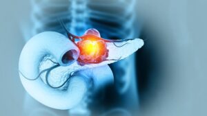 Siapa Sangka? Tanaman Populer Ini Jagoan Lawan Kanker, Lho!